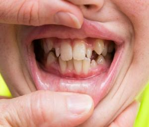 किडलेले दात आणि अन्न अडकण्याच्या समस्येवर डॉक्टर सांगतात ‘हे’ प्रभावी उपाय!